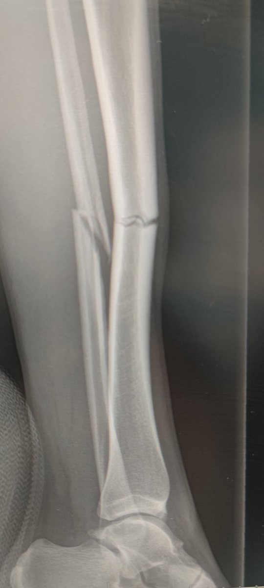 laura_f1nch's tweet photo. The human body is pretty incredible, 3 weeks post injury and I feel like a proud mother seeing my tib and fib healing themselves up nicely 🥹 https://t.co/r7MzWyDnBX