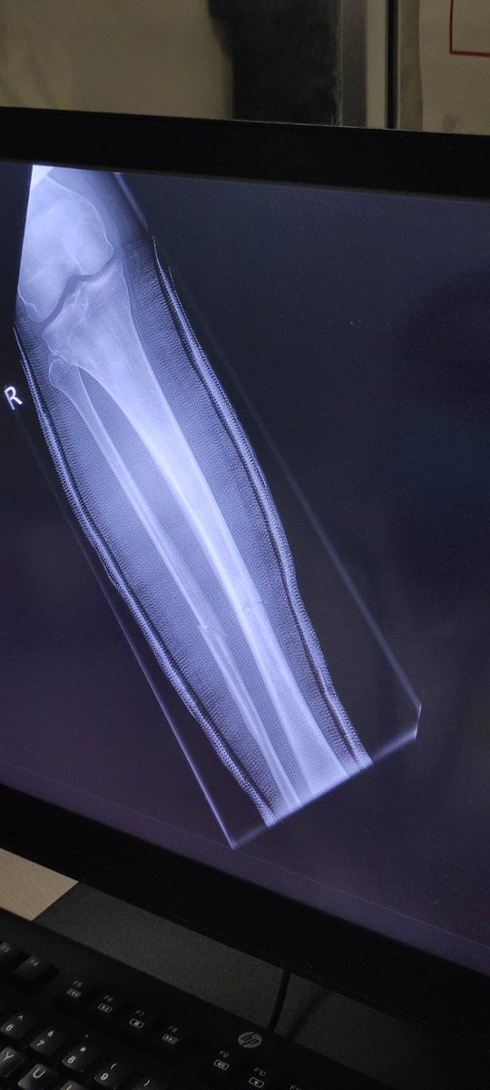 laura_f1nch's tweet photo. The human body is pretty incredible, 3 weeks post injury and I feel like a proud mother seeing my tib and fib healing themselves up nicely 🥹 https://t.co/r7MzWyDnBX