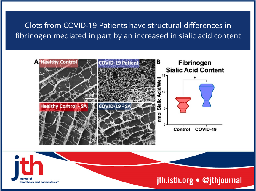 JTH (@jthjournal) on Twitter photo <a href="/clotgirlsummer/">Nina Moiseiwitsch</a> et al. reports that fibrinogen from #COVID-19 patients are structurally denser and less porous Differences mediated by differential sialylation bit.ly/3EL1clJ <a href="/BrownLab_NCSU/">Ashley Brown</a> <a href="/clotgirlsummer/">Nina Moiseiwitsch</a> et al. reports that fibrinogen from #COVID-19 patients are structurally denser and less porous Differences mediated by differential sialylation bit.ly/3EL1clJ <a href="/BrownLab_NCSU/">Ashley Brown</a>