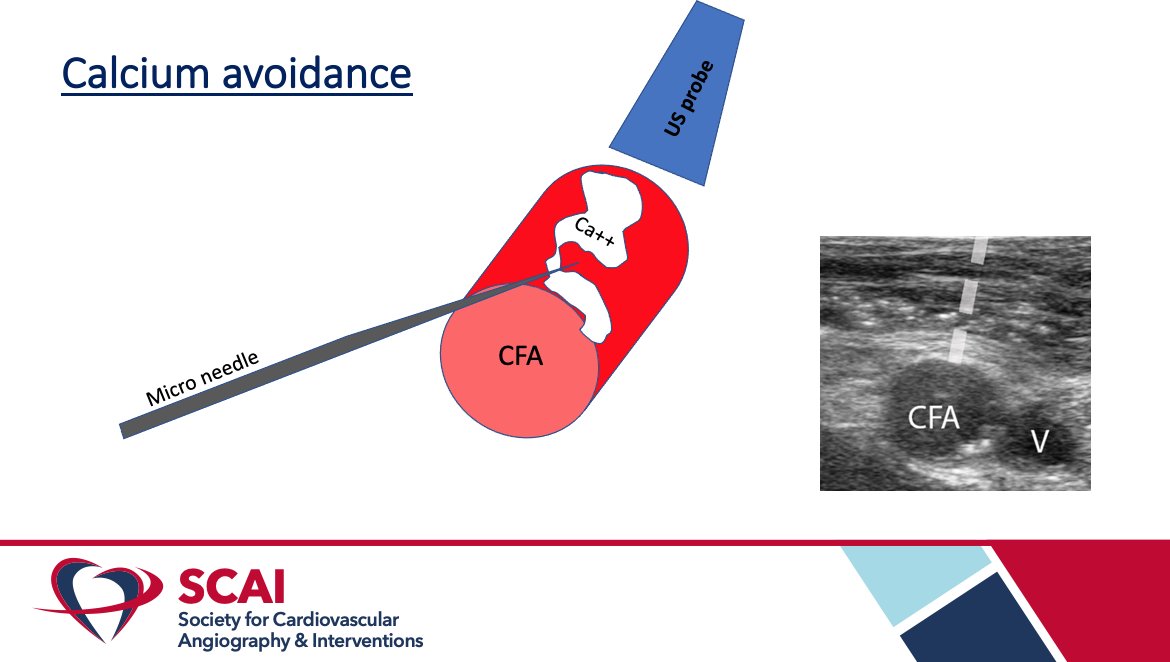 HadyLichaaMD's tweet image. #CathTips on #LargeBoreAccess &amp;amp; #DryClosure

@SukhNijjer @kerrigjl @sbrugaletta @AGoldsweig @behnam_tehrani @NavinKapur4 @adityadoc1 @prkothapalli @monteleoneMD @DrSethdb @timir_paul @KardiologieHH @PCRonline @GoranEBC @DocSavageTJU @jaygirimd @georgedangas @ArasiMaran @ekgpdx