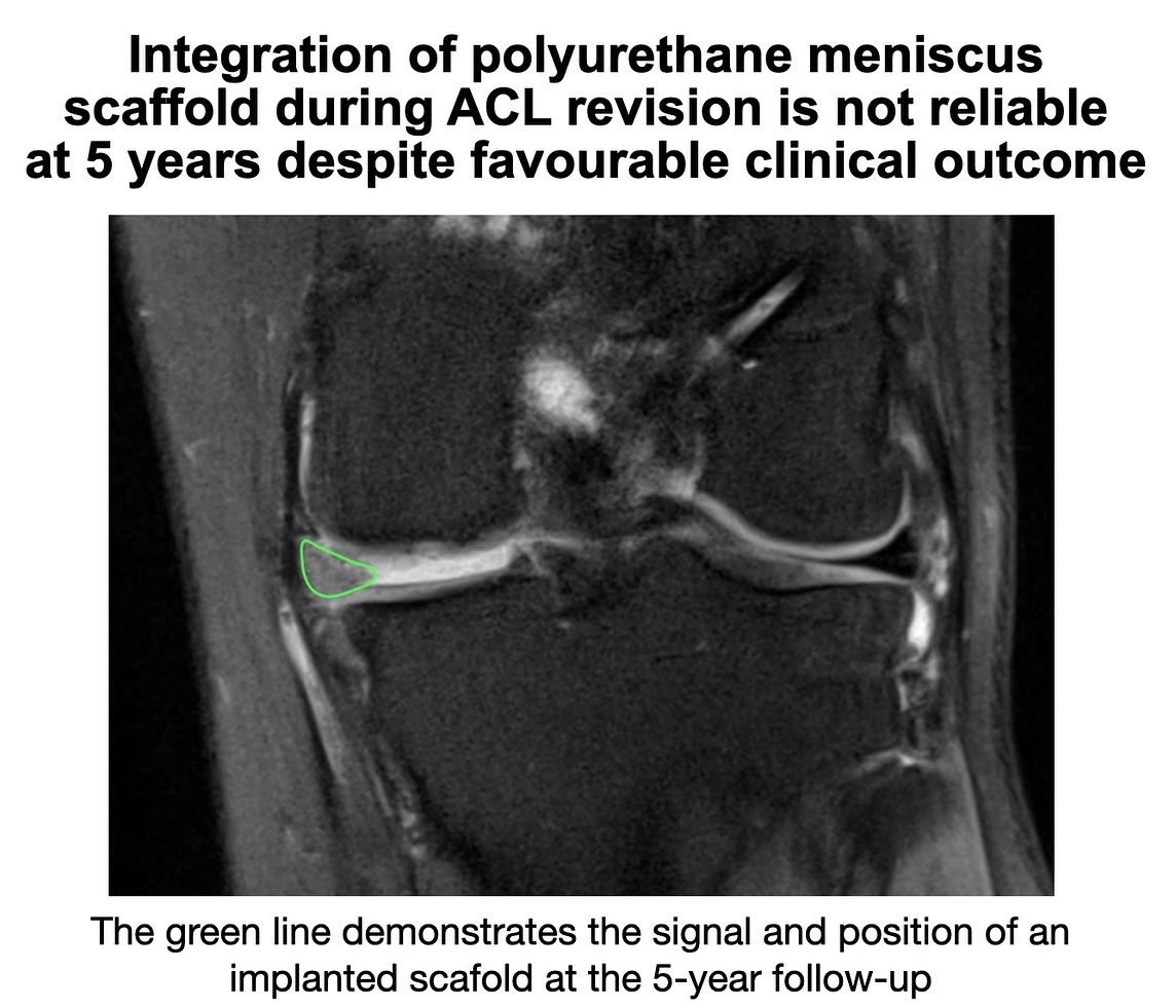 KSSTA's tweet photo. Simultaneous #ACLreconstruction and partial #meniscusreplacement by a polyurethane scaffold provide favourable outcomes at five-year. However, #MRI evaluation suggests that integration of the #scaffold is not consistent.

#sportsmedicine #radiology

Link: https://t.co/SOhrQ9r74q https://t.co/r5Tof2D0M6