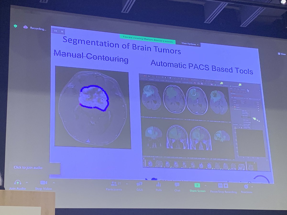 Ali Nabavizadeh (@ali_nabavizadeh) on Twitter photo <a href="/MariamAboian/">Mariam Aboian</a> work is truly a herculean effort in developing an efficient and agile system for #braintumor quantitative imaging/treatment monitoring. A masterclass in academia-industry partnership.Can’t think of a better collaborator <a href="/NeuroOncRadio/">BrainTumorImagingResearchGroup</a> @CBTNetwork <a href="/Visage_Imaging/">Visage Imaging</a> <a href="/MariamAboian/">Mariam Aboian</a> work is truly a herculean effort in developing an efficient and agile system for #braintumor quantitative imaging/treatment monitoring. A masterclass in academia-industry partnership.Can’t think of a better collaborator <a href="/NeuroOncRadio/">BrainTumorImagingResearchGroup</a> @CBTNetwork <a href="/Visage_Imaging/">Visage Imaging</a>