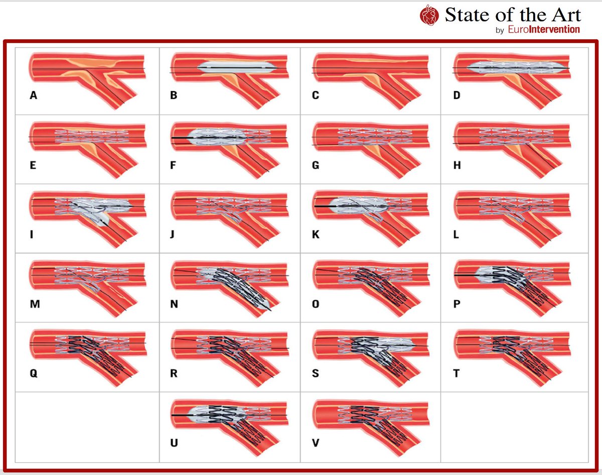 STATE OF THE ART ON BIFURCATIONS: In this #EIJBestOf review the authors describe technically important characteristics of bifurcation lesions and summarize the evidence and outcomes supporting contemporary #bifurcation techniques. <a href="/Ryvetsprog/">David Hildick-Smith</a> ow.ly/bCa850Lbc7J