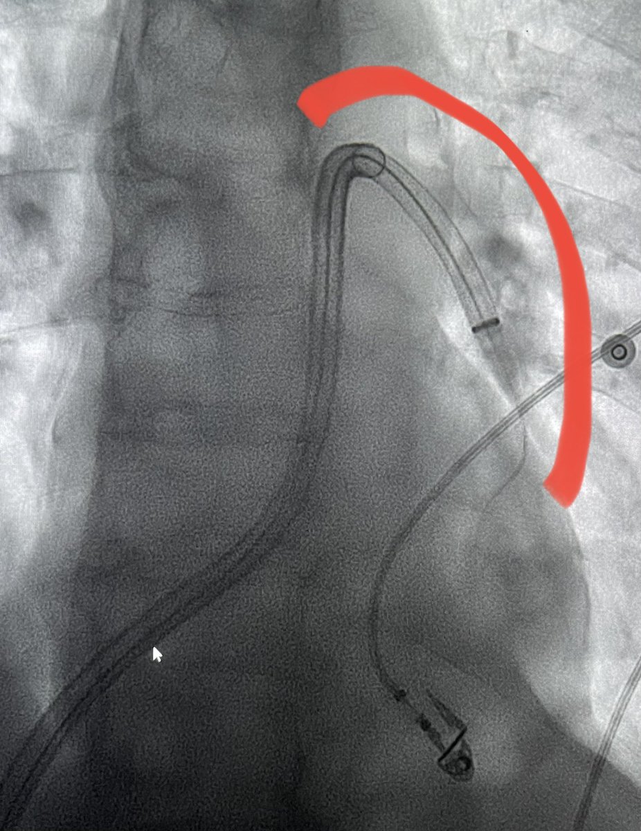 Ambarish Bhat (@bhat_ambarish) on Twitter photo #T20 curve is a terrific upgrade to the INARI tool box. If #T24 is not pulling the left side clot, have low threshold to use the” curve”. Works all the time. <a href="/SIR_ECS/">SIR ECS</a> <a href="/SIRspecialists/">Society of Interventional Radiology</a> <a href="/SIRRFS/">SIR RFS</a> <a href="/ISVIRIndia/">ISVIR India</a> <a href="/CAIRweb/">Canadian Association for Interventional Radiology</a> <a href="/InariMedical/">Inari, now part of Stryker</a> #clotwarrior #PE #T20 curve is a terrific upgrade to the INARI tool box. If #T24 is not pulling the left side clot, have low threshold to use the” curve”. Works all the time. <a href="/SIR_ECS/">SIR ECS</a> <a href="/SIRspecialists/">Society of Interventional Radiology</a> <a href="/SIRRFS/">SIR RFS</a> <a href="/ISVIRIndia/">ISVIR India</a> <a href="/CAIRweb/">Canadian Association for Interventional Radiology</a> <a href="/InariMedical/">Inari, now part of Stryker</a> #clotwarrior #PE