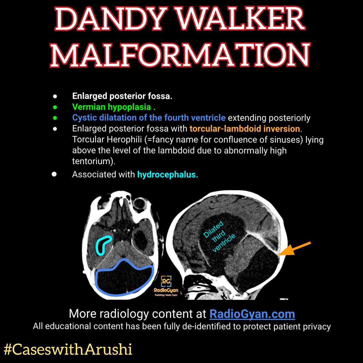 TeamRadioGyan's tweet photo. The answer to the last spotter is here. 
Hosted by #teamgyan member Dr. Arushi Gupta. 

Follow her on @radiologywithdrarushi for more.

#dandywalker #FOAMrad #radres #radiology #radiologia #radiogyan #studygram #study #learning https://t.co/2M4aOVhIvO