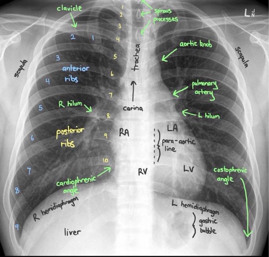 alemoyaal's tweet photo. Cómo #interpretar una #radiografía de #torax y conocer las principales estructuras vasculares que deben ser valoradas #tips #Emergency #medicine #Foamed #XRAY #thorax https://t.co/S8nMtKABiV