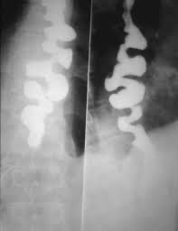 A middle aged woman presented with difficulty swallowing, chest pain &amp; weight loss for one month. Barium swallow revealed corckscrew pattern. What is the likely diagnosis? #Medtwitter (Image: Wikipedia)