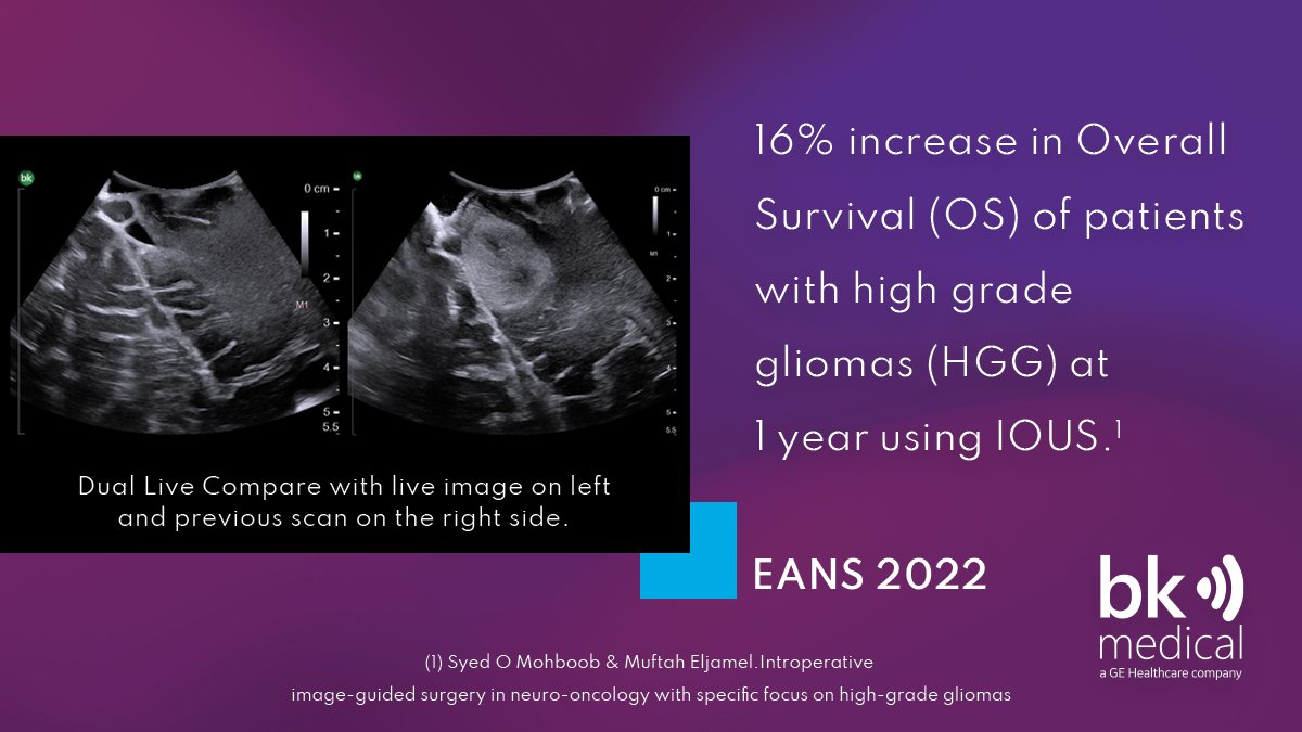 Neurosurgery - bkMedical (@neuro_bkmed) on Twitter photo Itās the first day of #EANS2022!
Visit Booth 26 to learn how you can use intraoperative ultrasound during neuro-oncology surgery to determine extent of resection and assess for residual tumor.
hubs.la/Q01pPS4Q0
<a href="/EANSonline50/">European Association of Neurosurgical Societies</a> Itās the first day of #EANS2022!
Visit Booth 26 to learn how you can use intraoperative ultrasound during neuro-oncology surgery to determine extent of resection and assess for residual tumor.
hubs.la/Q01pPS4Q0
<a href="/EANSonline50/">European Association of Neurosurgical Societies</a>
