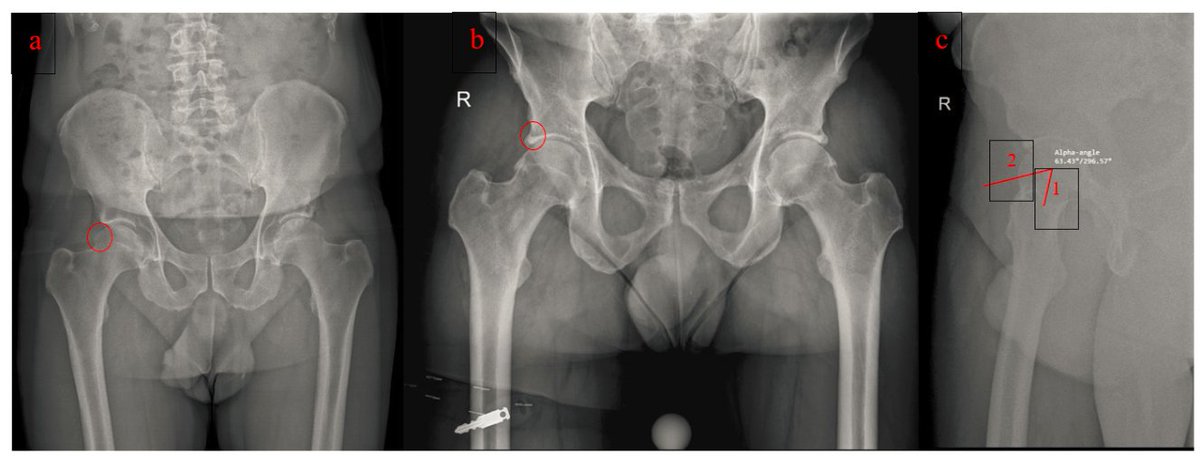 Conservative vs. Surgical Management for Femoro-Acetabular Impingement: A Systematic Review of Clinical Evidence 

🦵🦵👇👇

mdpi.com/2077-0383/11/1…