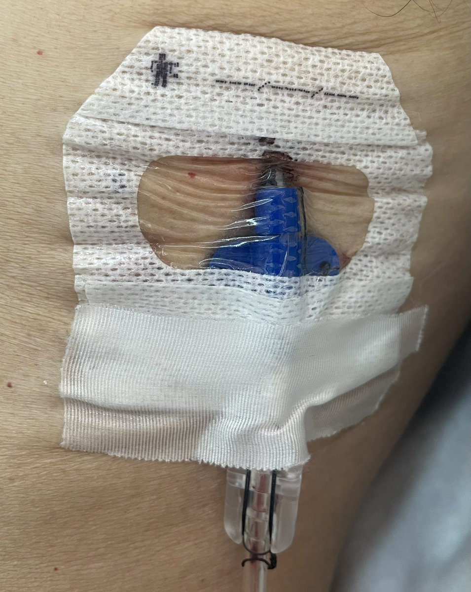 RenzoMh10's tweet photo. Paciente varón con disnea y dolor torácico intenso, Dx:Adenocarcinoma Pulmonar primario con metástasis a pleura. (Pulmón atrapado).@H2deMayo https://t.co/rS5LX7Tor6