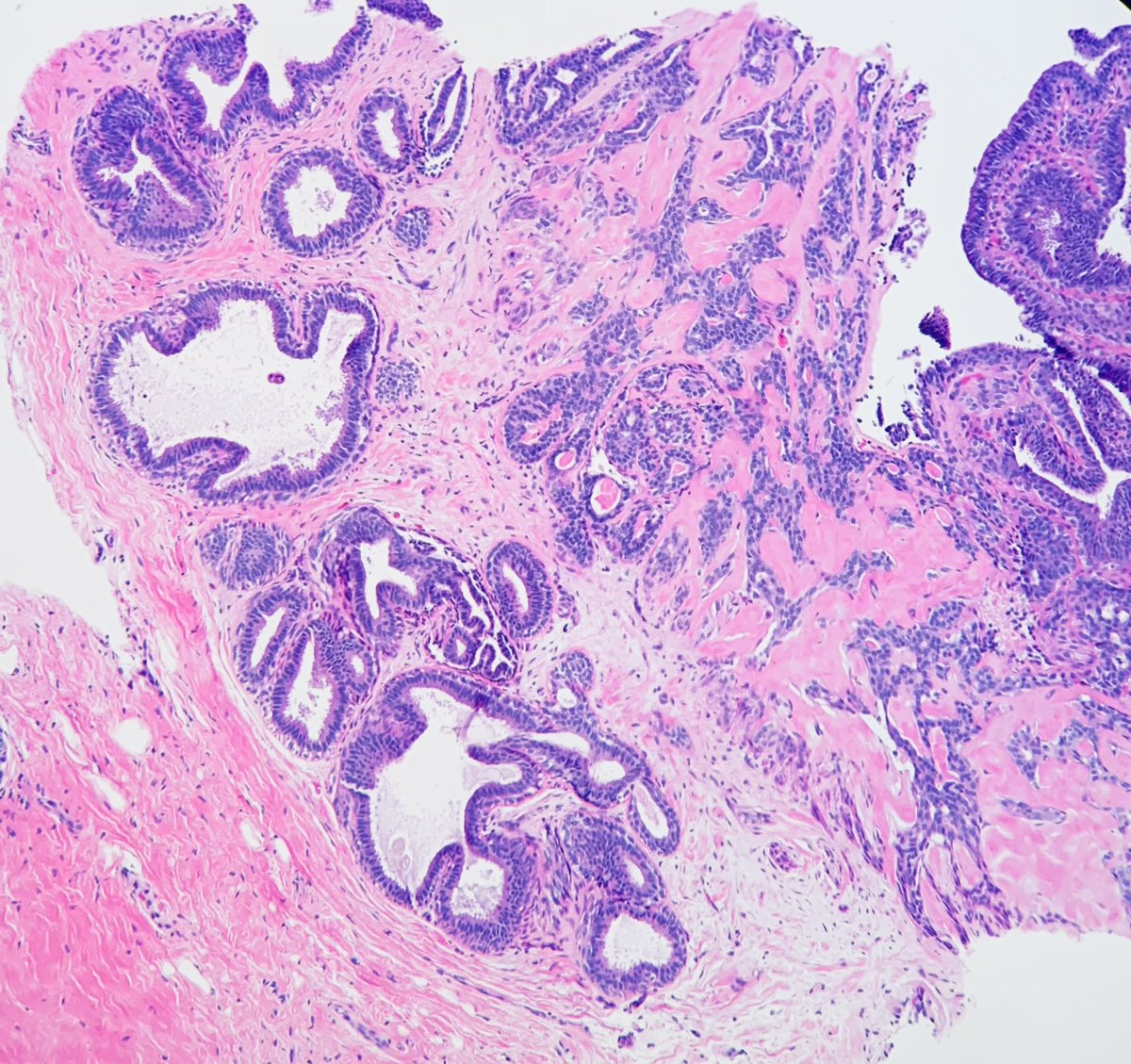 Janiranavarro's tweet image. Breast  - core biopsy series 💉 
Intraductal papilloma 
#breastpath #everydaybreast #pathology #PathResident #pathfellow #beautyinthebenign #PathTwitter