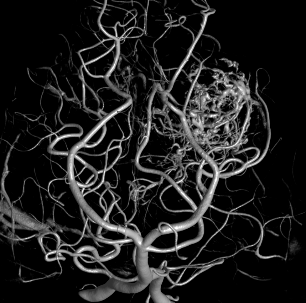 eytanraz's tweet photo. At #BANANA2022 ๐ there will be a whole workshop on how to do #CBCT angiography aka #DynaCT, below an example of its application for understanding in depth the supply of an extremely hypervascular tumor. Link: https://t.co/tfHrHuv8Sk https://t.co/GmWP1S2C5z