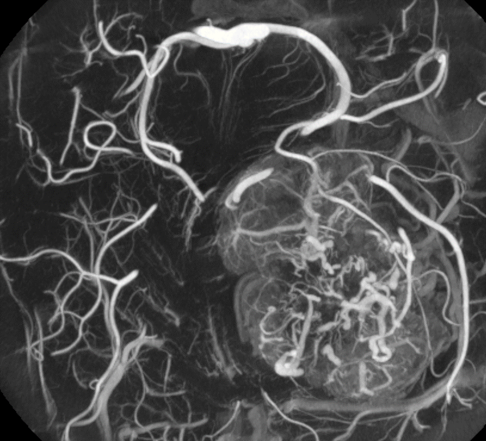 eytanraz's tweet photo. At #BANANA2022 ๐ there will be a whole workshop on how to do #CBCT angiography aka #DynaCT, below an example of its application for understanding in depth the supply of an extremely hypervascular tumor. Link: https://t.co/tfHrHuv8Sk https://t.co/GmWP1S2C5z