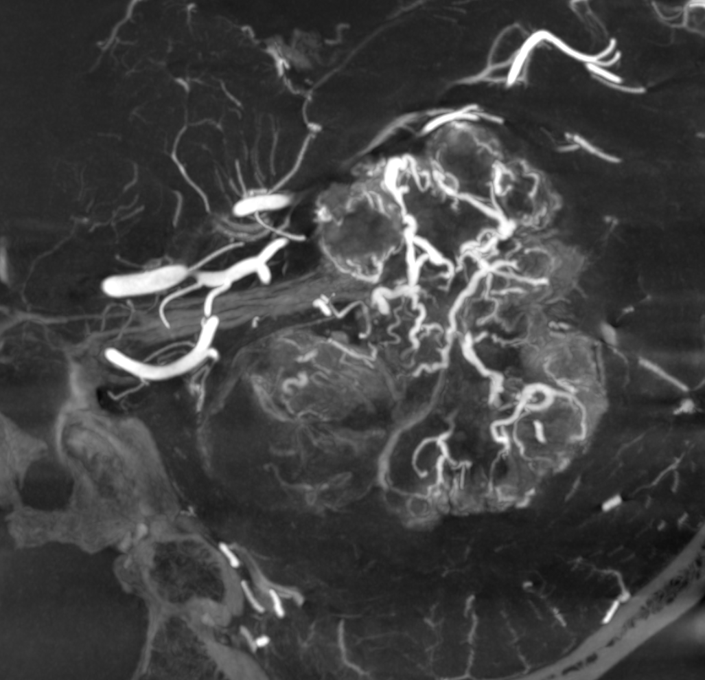 eytanraz's tweet photo. At #BANANA2022 ๐ there will be a whole workshop on how to do #CBCT angiography aka #DynaCT, below an example of its application for understanding in depth the supply of an extremely hypervascular tumor. Link: https://t.co/tfHrHuv8Sk https://t.co/GmWP1S2C5z
