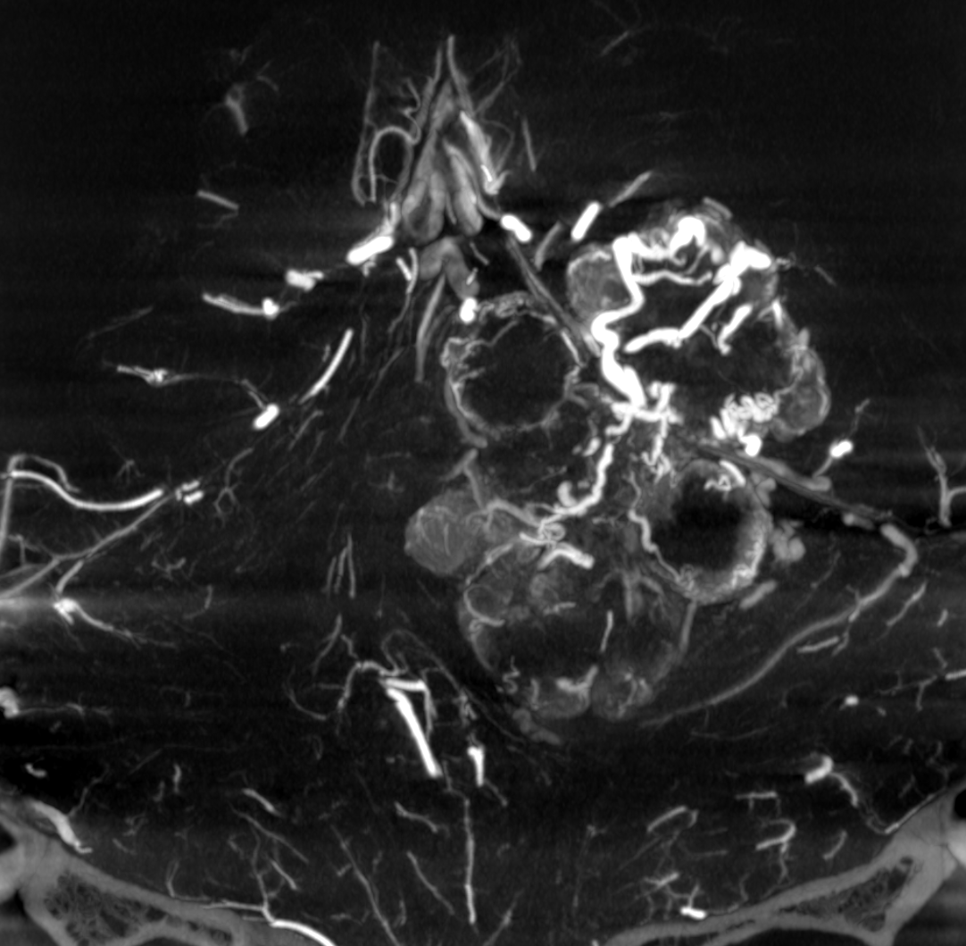 eytanraz's tweet photo. At #BANANA2022 ๐ there will be a whole workshop on how to do #CBCT angiography aka #DynaCT, below an example of its application for understanding in depth the supply of an extremely hypervascular tumor. Link: https://t.co/tfHrHuv8Sk https://t.co/GmWP1S2C5z