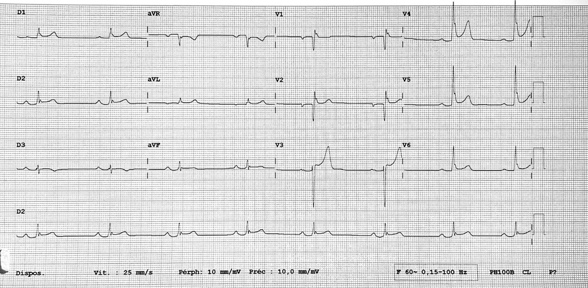 Can’t resist to tweet this #ecgfirst of a 30 yo man with thoracic pain. #Cardiotwitter #Epeeps What’s the most likely diagnosis and why? Check poll