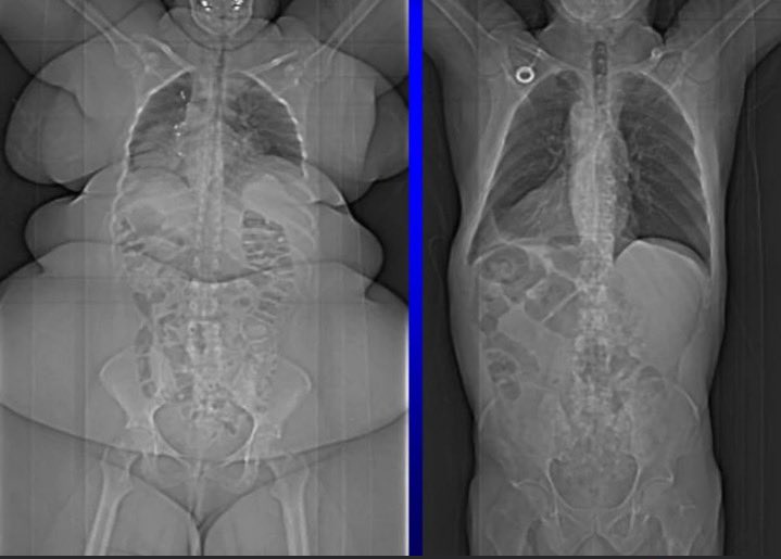 Skinny person x-rays compared to overweight persons.