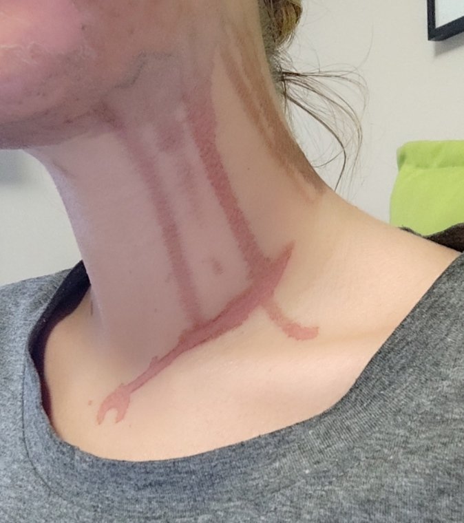 paulantsov's tweet photo. La peor decisión del 2022? Ir a hacerme un peeling químico a la clínica de la doctora Ana Santamaría Robredo en la calle Velázquez 122 en Madrid y luego acabar con el cuello con quemaduras superficiales porque Ana tuvo 0 cuidado al aplicar el ácido del peeling 🤩

🧵👇🏼 https://t.co/FVe4dPhp6U