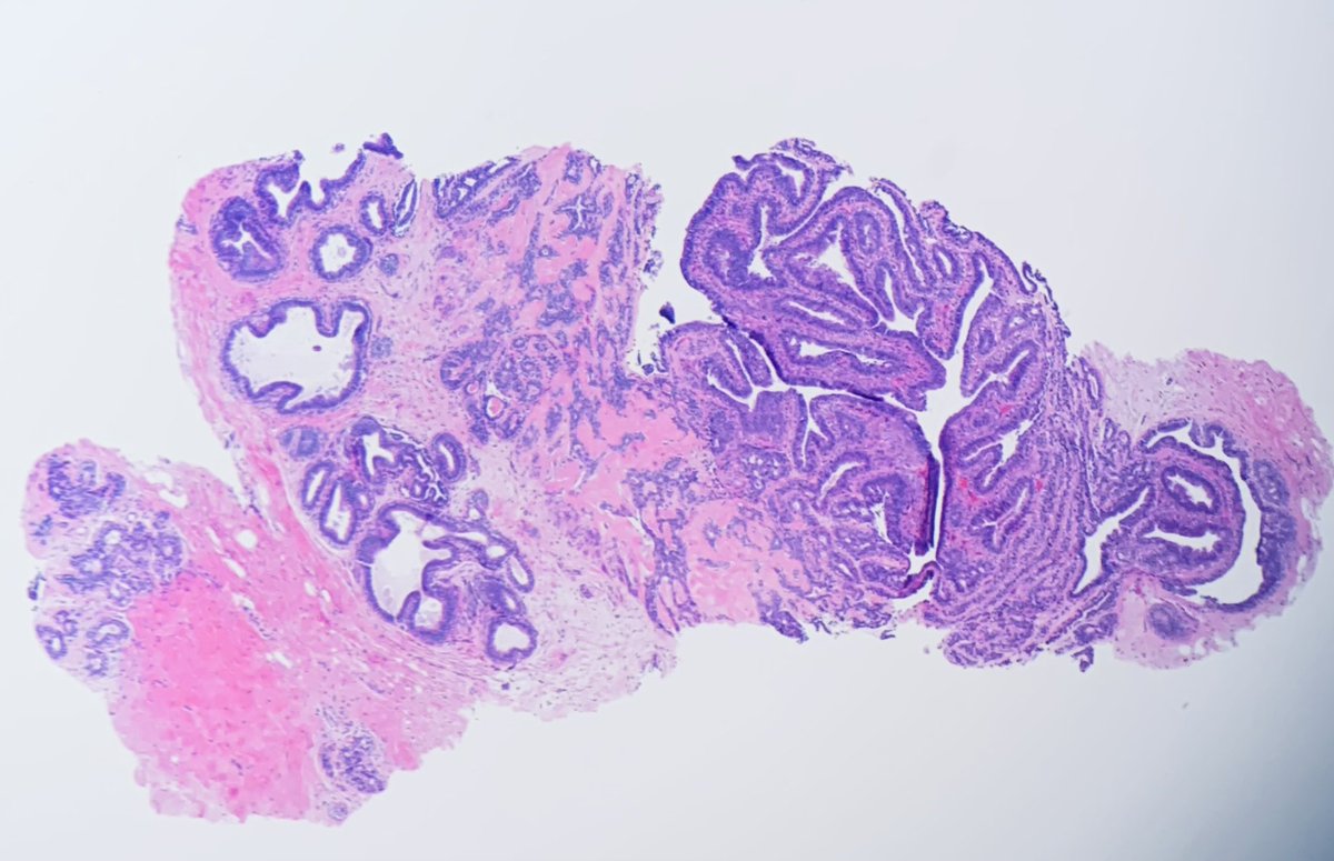 Janiranavarro's tweet image. Breast  - core biopsy series 💉 
Intraductal papilloma 
#breastpath #everydaybreast #pathology #PathResident #pathfellow #beautyinthebenign #PathTwitter