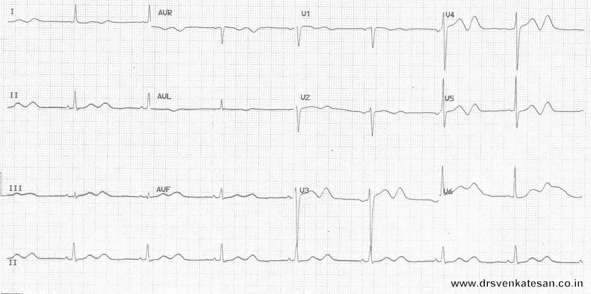 BrownJHM's tweet photo. A 52 year old man is admitted for bradycardia &amp; severe hypokalemia (1.9 mEq/L). What ECG abnormality is noticed here? #Medtwitter #CardioEd https://t.co/HwGBneTBDP https://t.co/clGfL0WLyA