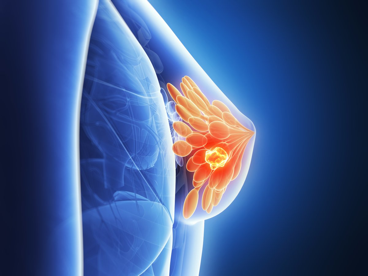 Despite advances in the treatment of breast cancer, challenges remain, such as the development of resistance to existing therapies, serious adverse events, and suboptimal treatment adherence. #bcsm | @jhaveri_komal @MSKCancerCenter ow.ly/pHlK50L9uBC
