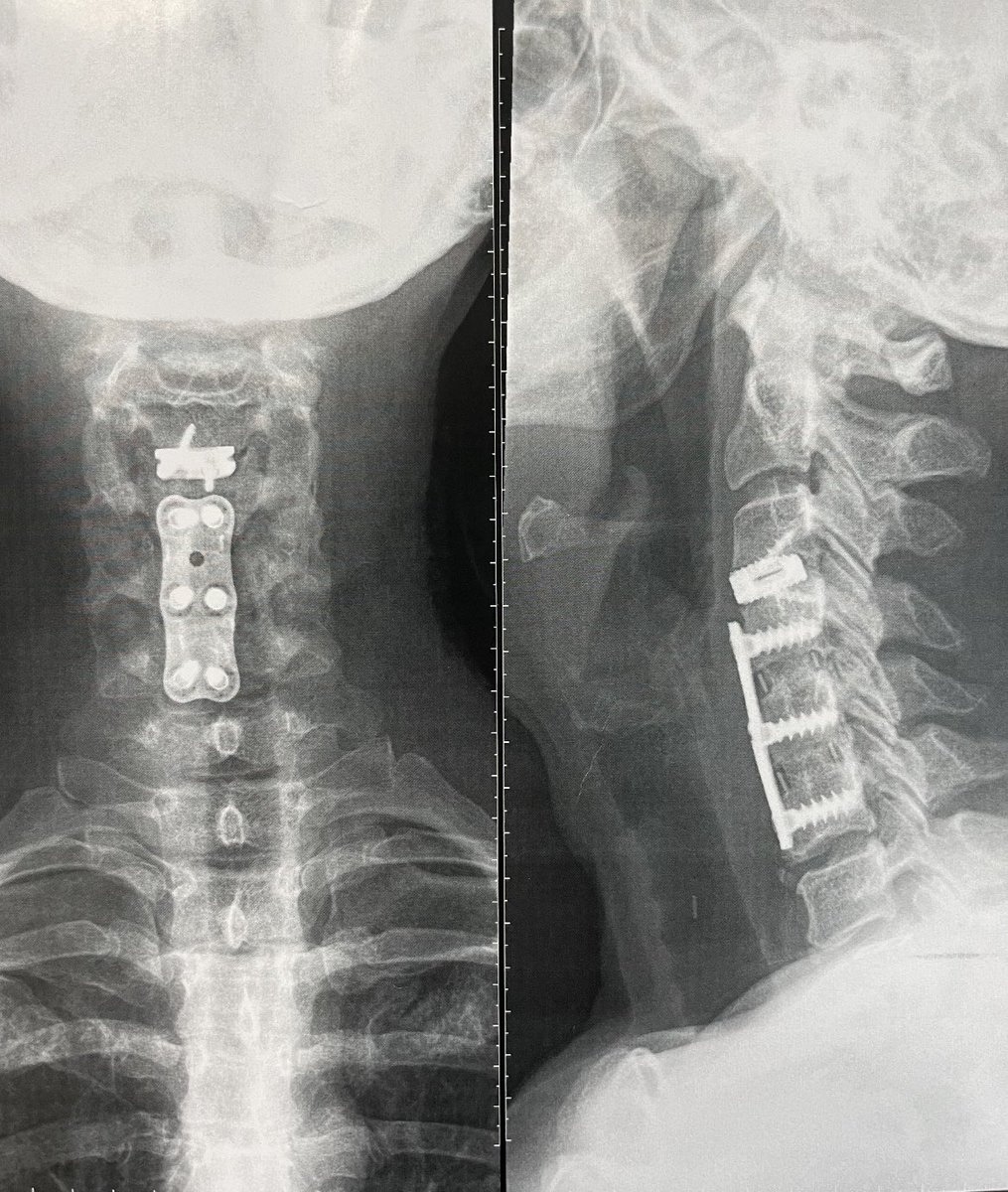 Dr Parajon (@drparajon) on Twitter photo <a href="/AliBaajMD/">Ali A. Baaj MD</a> When possible I always try to leave old plate. “Zero” profile cages with screws are a good option for these cases. <a href="/AliBaajMD/">Ali A. Baaj MD</a> When possible I always try to leave old plate. “Zero” profile cages with screws are a good option for these cases.