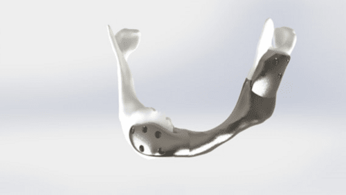 APMEN_Asia's tweet photo. Another successful breakthrough for cancer patients!
A titanium jaw implant without compromising daily activities ---> https://t.co/HlY6fm5eLW
#implantsurgery #3dprinting #medical #titanium #additivemanfacturing https://t.co/97Ys1mwCsi