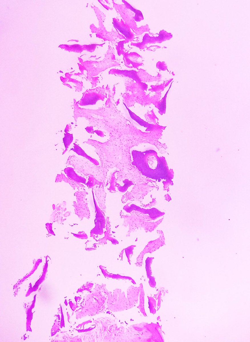 Praachy27's tweet photo. Gearing up the festive week with spotter- Fibrous Dysplasia of distal radius . #APCON2022 #APCON2022PathTwitter @Swathiprabhu5 @archibhat3 @fanbatao @VijayPatho https://t.co/WuMl8hiQCb