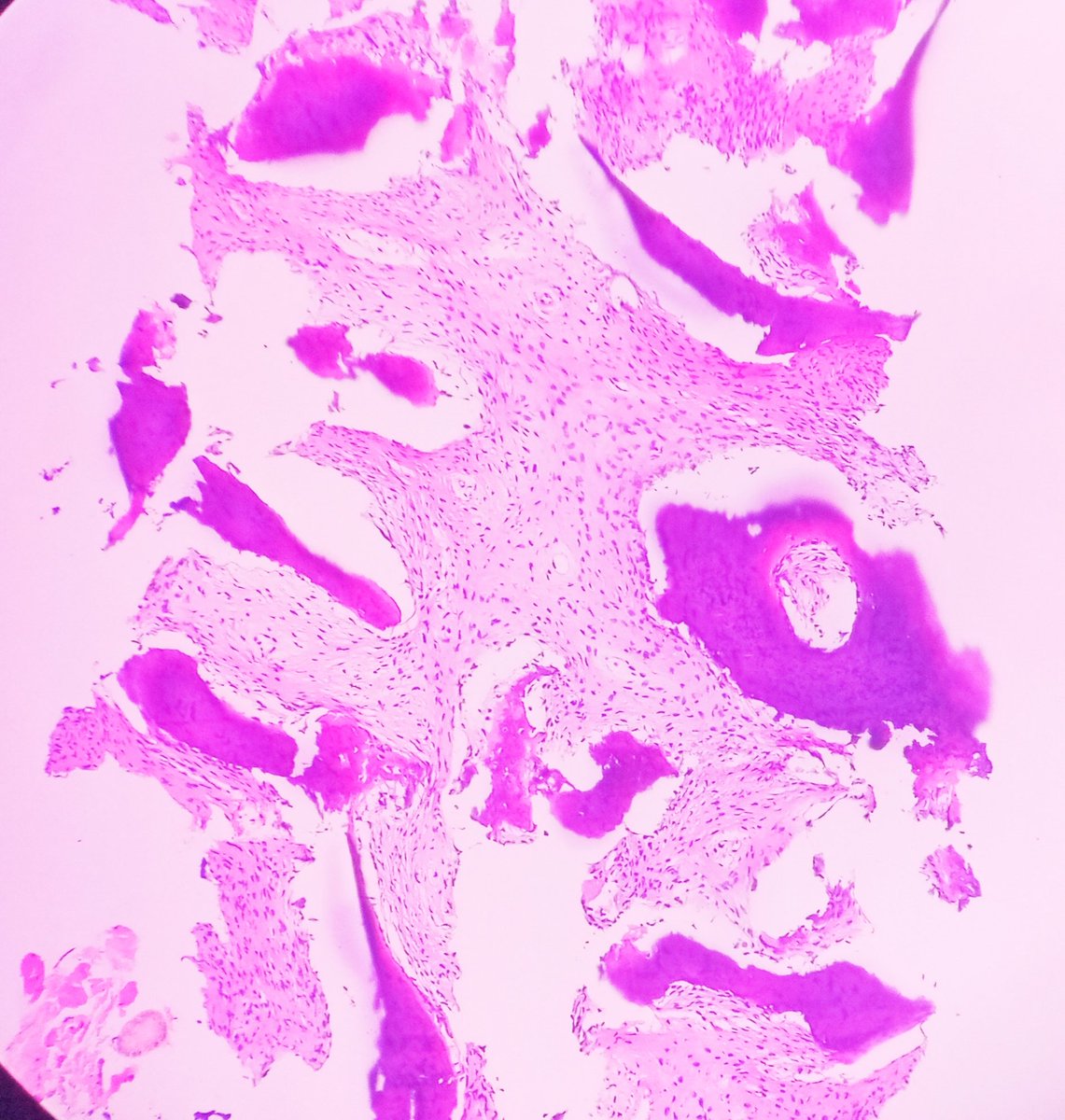Praachy27's tweet photo. Gearing up the festive week with spotter- Fibrous Dysplasia of distal radius . #APCON2022 #APCON2022PathTwitter @Swathiprabhu5 @archibhat3 @fanbatao @VijayPatho https://t.co/WuMl8hiQCb