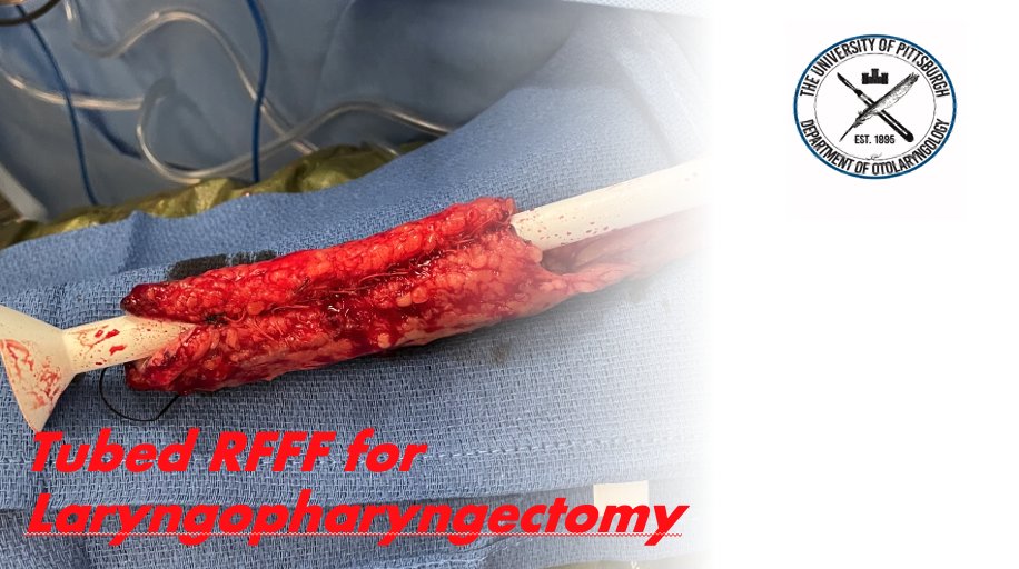 MarkKubikMD's tweet photo. Case of the week. Not my first choice for tubed reconstruction but RFFF was selected due to BMI / skin thickness of the thigh. https://t.co/4iO3KluUJg