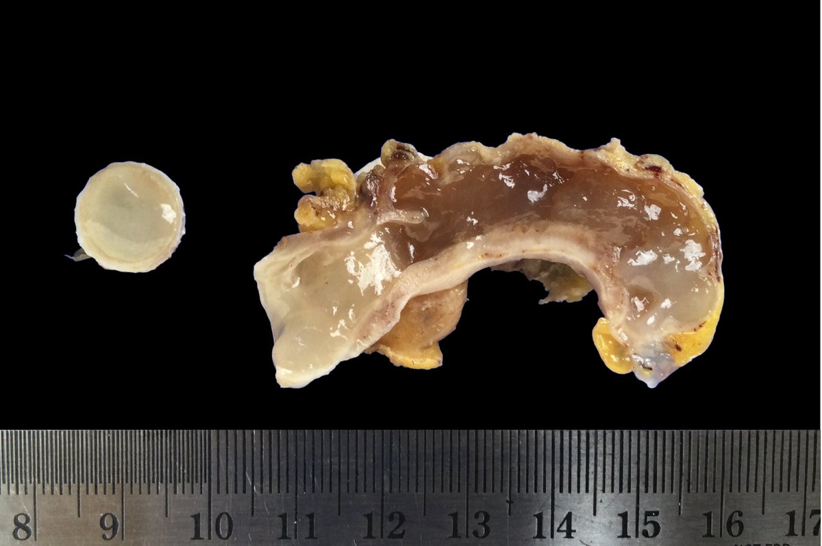 55yo, F. Appendix.