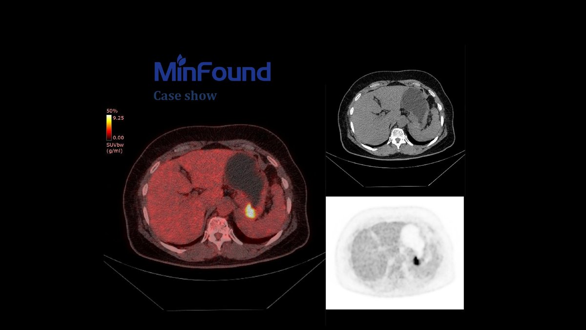 MinfoundMedical's tweet photo. 2) Lung cancer, Female, 73yr, BMI* 20,1, 7.13 mCi, 80s/bed*3 beds
3) Lymphoma, Female, 70yr, BMI* 28, 8.66 mCi, 128s/bed*3 beds
*BMI was calculated by age, gender, height and weight
#petct #medicalimaging #radtech #oncology #lymphoma #abdominal #lungcancer #clinicalapplication https://t.co/HABhAYNh5z