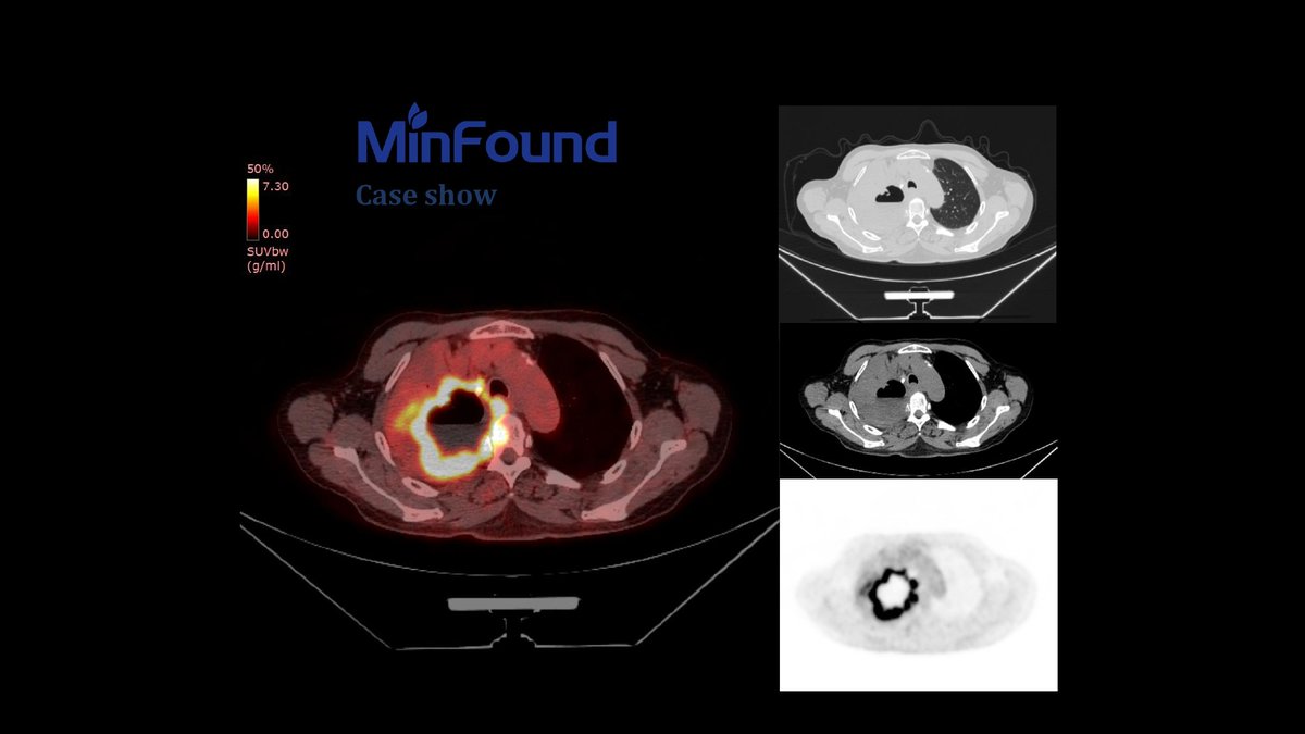 MinfoundMedical's tweet photo. 2) Lung cancer, Female, 73yr, BMI* 20,1, 7.13 mCi, 80s/bed*3 beds
3) Lymphoma, Female, 70yr, BMI* 28, 8.66 mCi, 128s/bed*3 beds
*BMI was calculated by age, gender, height and weight
#petct #medicalimaging #radtech #oncology #lymphoma #abdominal #lungcancer #clinicalapplication https://t.co/HABhAYNh5z