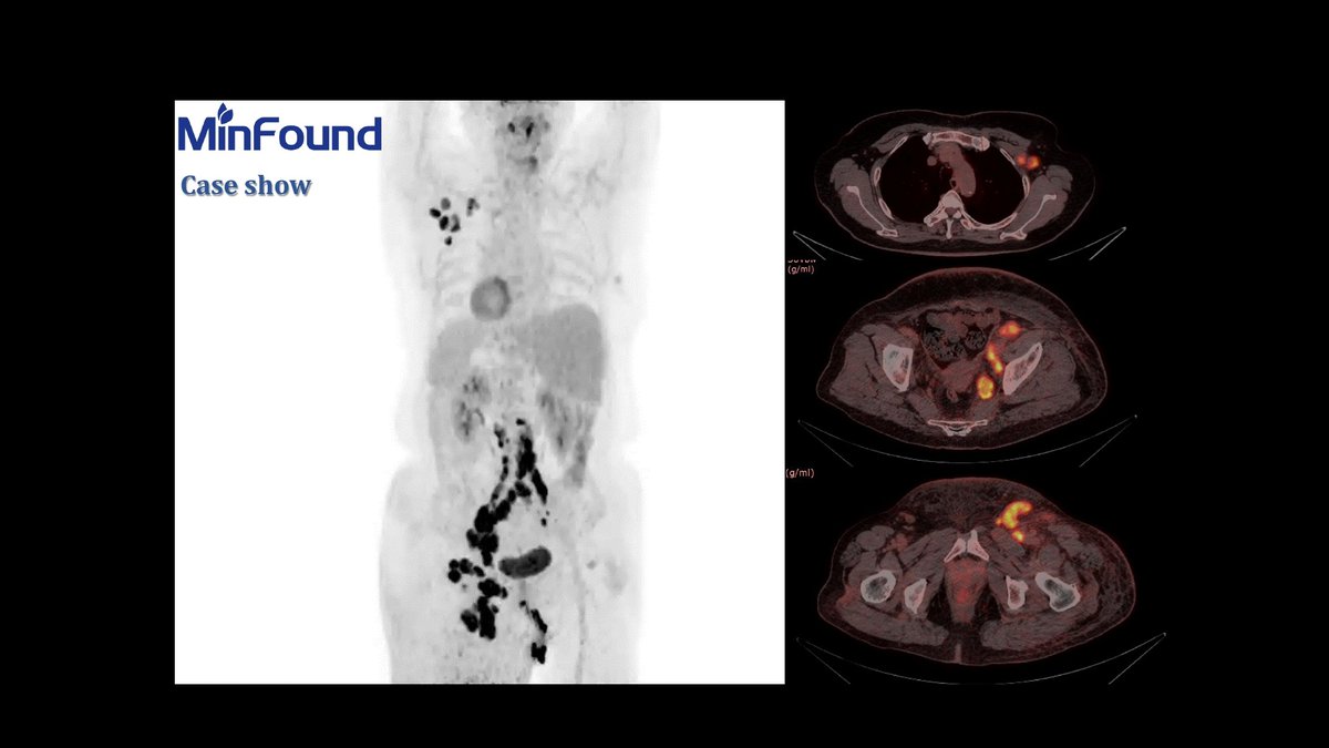 MinfoundMedical's tweet photo. 2) Lung cancer, Female, 73yr, BMI* 20,1, 7.13 mCi, 80s/bed*3 beds
3) Lymphoma, Female, 70yr, BMI* 28, 8.66 mCi, 128s/bed*3 beds
*BMI was calculated by age, gender, height and weight
#petct #medicalimaging #radtech #oncology #lymphoma #abdominal #lungcancer #clinicalapplication https://t.co/HABhAYNh5z
