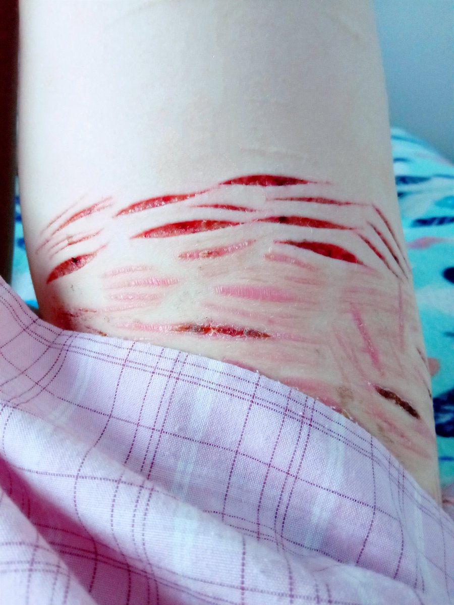 suic_princess's tweet photo. i wanna cover my body entirely in cuts and bruises, not leave a single inch unharmed

styrotwt beanstwt bloodtwt barcodetwt 198twt 988twt https://t.co/jqta2atLfp