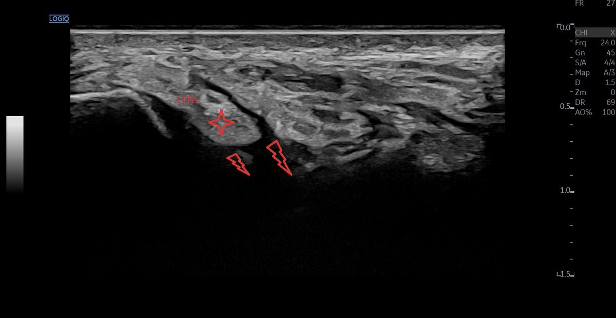 SportklinikBern's tweet photo. #cas chronic rupture of the #ltfa after #anklesprain years ago - now instability and pain when loading in sports #mskus #pocus #pocushub #GElogiqE10r3 #hockeystickprobe 24mHz https://t.co/rNKZeTkHoN