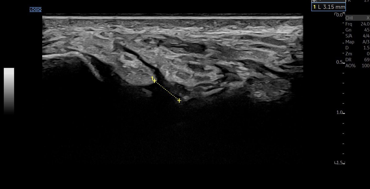 SportklinikBern's tweet photo. #cas chronic rupture of the #ltfa after #anklesprain years ago - now instability and pain when loading in sports #mskus #pocus #pocushub #GElogiqE10r3 #hockeystickprobe 24mHz https://t.co/rNKZeTkHoN