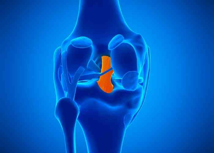 drprovencher's tweet photo. What is #PCLSurgery?
If this is necessary to return full function & stability to the #kneejoint, Dr. Provencher will reconstruct the torn ligament with a graft using an arthroscopic approach. An allograft is typically utilized during a #PCLreconstruction. https://t.co/ThEQ5FEnBM https://t.co/SRewYBKrVG