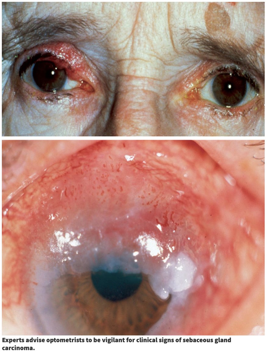 revoptom's tweet image. Comanaging Outside of Eye Care: Recognize These Systemic Risks
Learn how to trade expertise with doctors in other medical disciplines for the betterment of your shared patients.
reviewofoptometry.com/article/comana…
#optometry #eyecare #systemicdisease