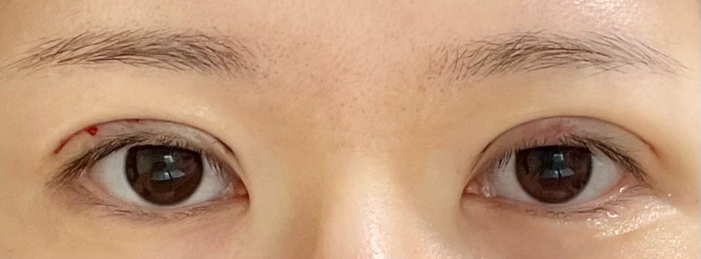 rrr1_yu's tweet photo. 10/14に二重切開して1時間後、おうちに帰ってきてすぐ撮った写真。
無加工なので色々ごめんなさい😢 https://t.co/cgC2xSLq4s