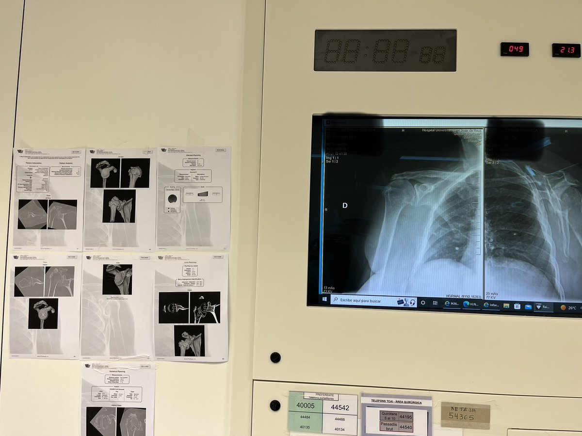 Good habits learned from #fellowship with @RDShoulder 
 #surgicalplanning #bioRSA #stryker #tornier @StrykerSportMed @TornierOR #arthroplasty #shoulder