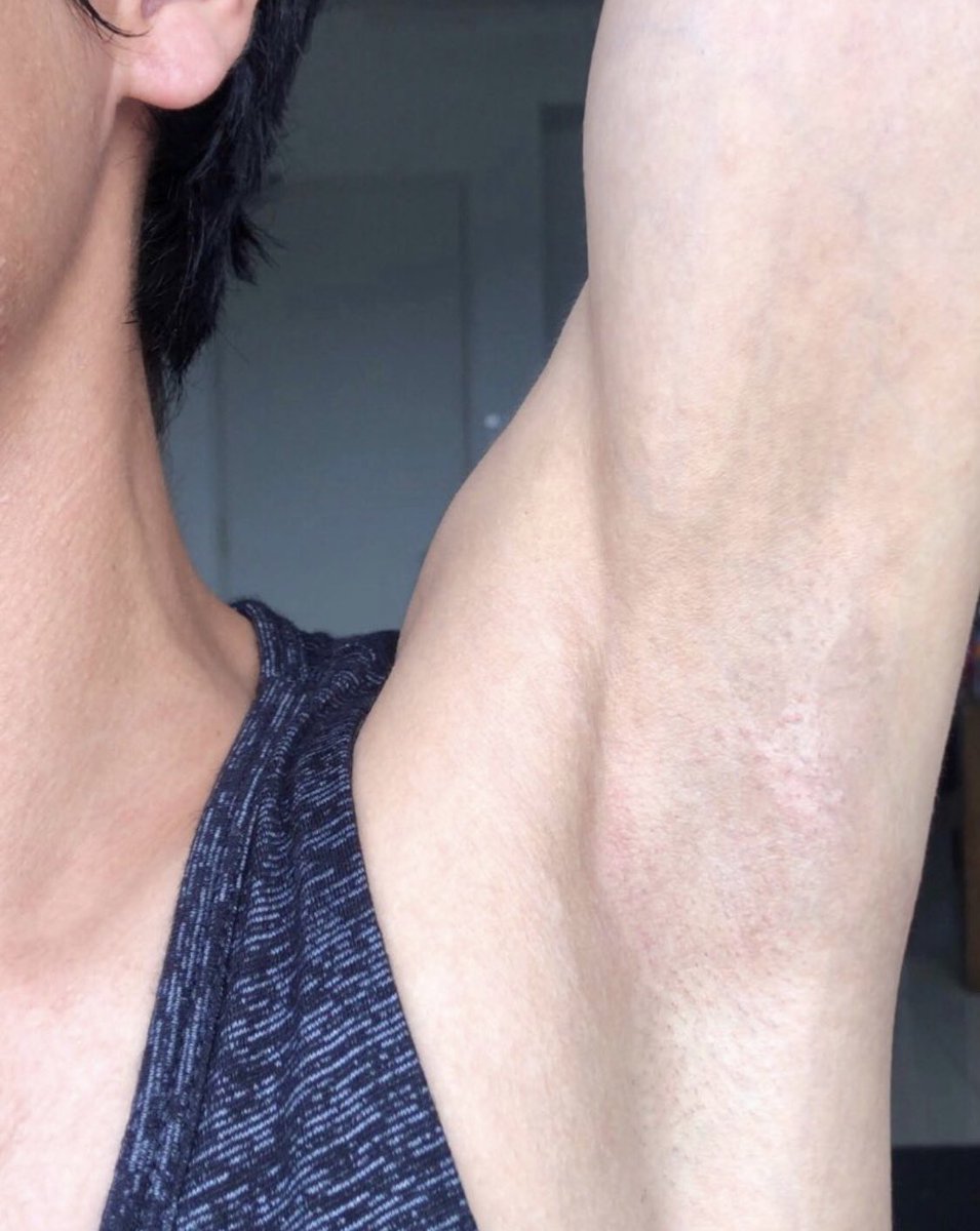 notmijiiii's tweet photo. Kalau korang susah sangat lepas shave je ada razor bump.

I would recommend this product yang “razor bump-less” https://t.co/BzuUeuU9bh