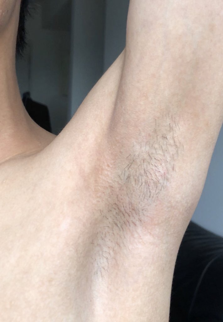 notmijiiii's tweet photo. Kalau korang susah sangat lepas shave je ada razor bump.

I would recommend this product yang “razor bump-less” https://t.co/BzuUeuU9bh