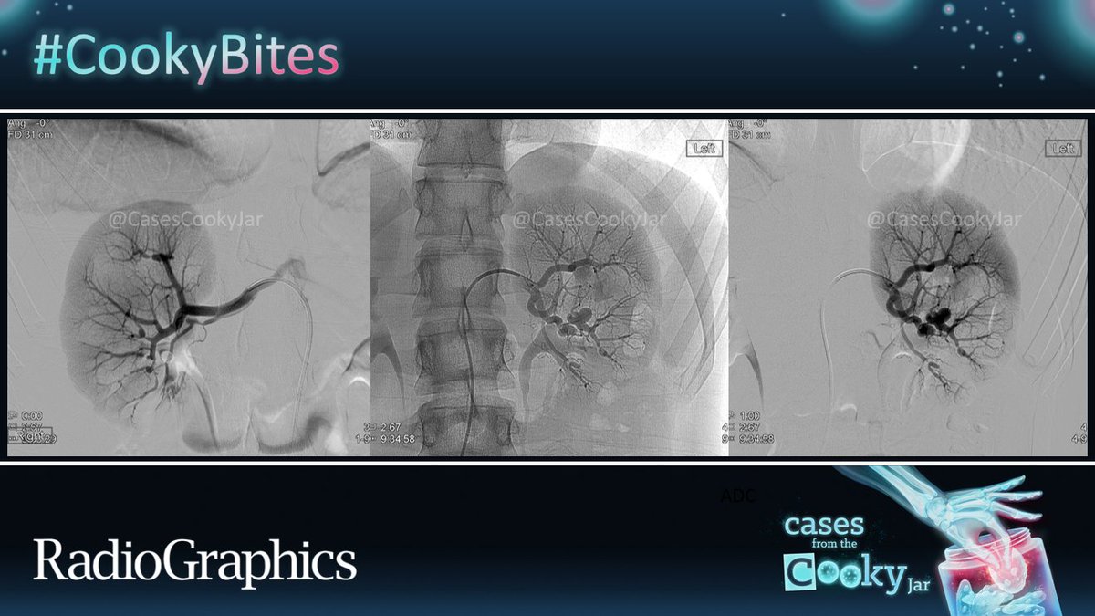 58-year-old man presents with fever and weight loss. What is the diagnosis❓ We’ll post the answer in 24h. Share companion cases with us using #CookyBites #82. We will RT the best cases! #RGphx @cookyscan1 @RadioGraphics