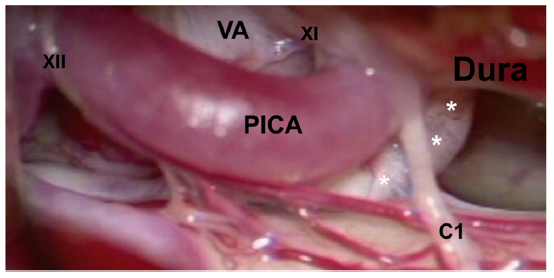 dr_sorenson's tweet photo. The far lateral craniotomy for CVJ dAVFs provides access to remarkable neuroanatomy. @ActaNeuro @GLanzinoNSGY 

https://t.co/WchoftH4qx https://t.co/yYux6da2qa