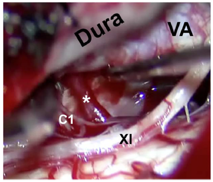 dr_sorenson's tweet photo. The far lateral craniotomy for CVJ dAVFs provides access to remarkable neuroanatomy. @ActaNeuro @GLanzinoNSGY 

https://t.co/WchoftH4qx https://t.co/yYux6da2qa