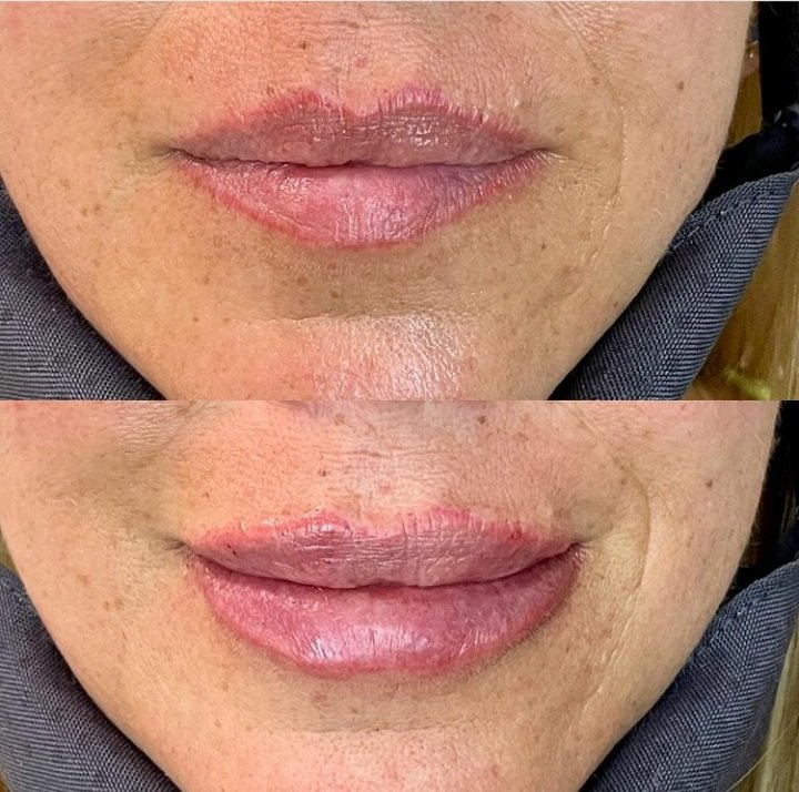 lafemmeimplants's tweet photo. Reposted from @lafemmeimplants Rellenos Dèrmicos HAFILLER® a base de Àcido Hialurònico

¿Ya los conoces? HAFILLER® es un producto con resultados de la larga duraciòn, gracias a sus propiedades viscoelàsticas

#HAFILLER #ÁCIDOHIALURÓNICO #RellenosDérmicos #Venezuela https://t.co/ksJxOQMuS6