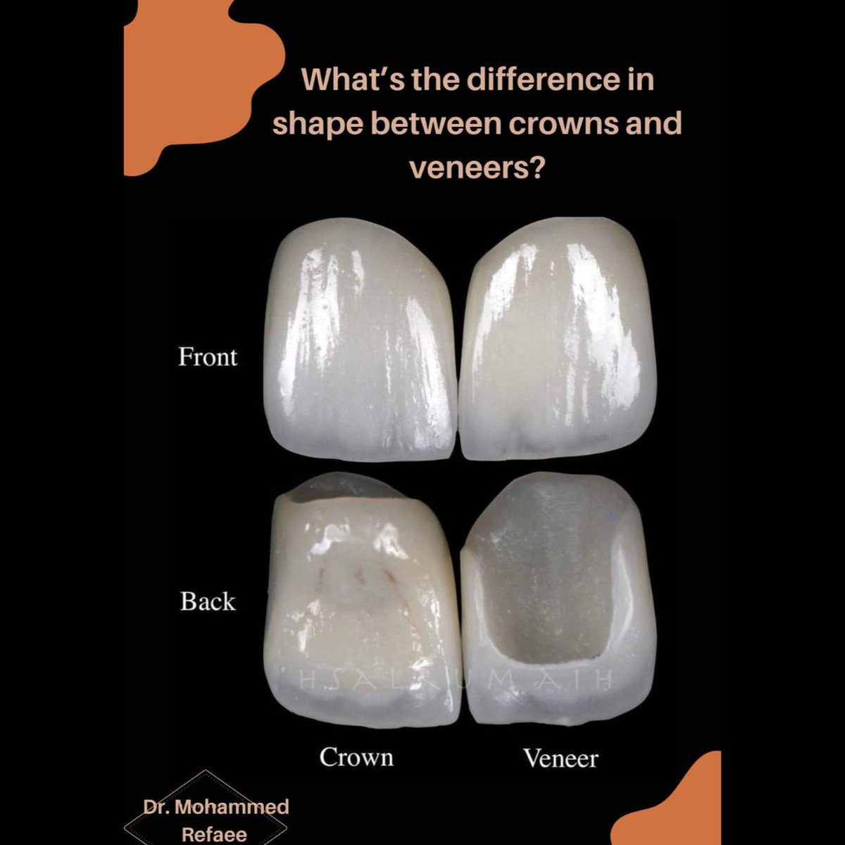 DrMohammedRefae's tweet photo. Veneers vs crowns 
#صفوة_المهيدب_لطب_الاسنان #تجميل #ابتسامة #ابتسامة_هوليود #اسنان #ايماكس #فينيرز #عدسات #تركيبات #تركيبات_اسنان #الجوف 
#safwatalmuhydb #dentist #dental_clinic #smile #smilemakeover #sakaka #aljouf #veneers #veneers_smile #crown #emax #emaxveneers #aesthetic https://t.co/bLmEKcCJdz