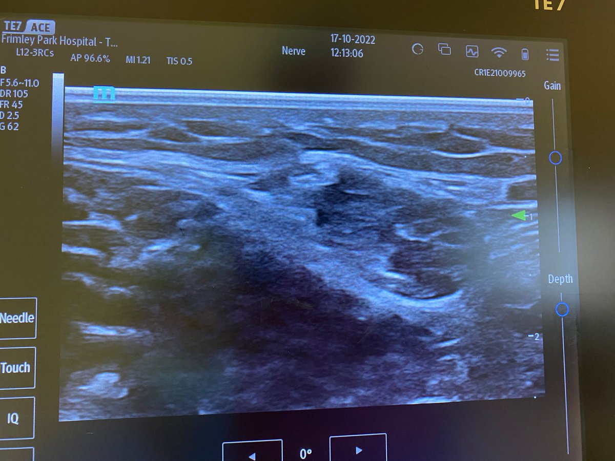 MadanNarayanan's tweet image. I can confirm, blocking posterior division of obturator doesn't have any sensory loss in the medial side of knee. Looks like only capsule is innervated  #bodyforscience