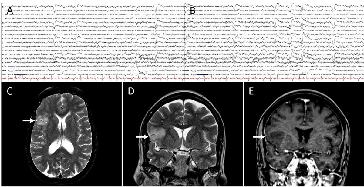 EpilepsiaJourn's tweet photo. Seizures in anti‐Hu‐associated extra‐limbic encephalitis: Characterization of a unique disease manifestation https://t.co/SK0ixftt1s

#epilepsy #Autoimmune #encephalitis #neuralantibody #ANNA1 @IlaeWeb @WileyNeuro @yesILAE @EpilepsiaJourn https://t.co/ACehhzdhmw